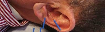 what are the differences between auricular medicine,
                        auriculotherapy and ear acupuncture